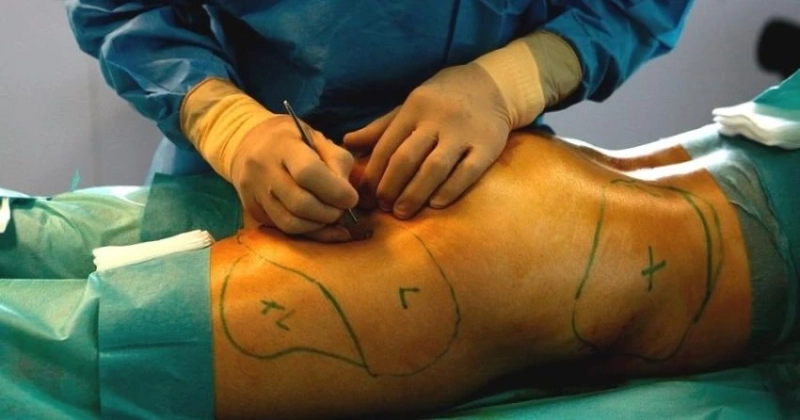 Lipoaspiração Renuvion em Recife com Alta Tecnologia