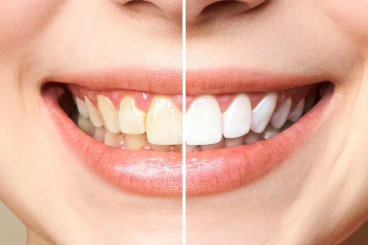 A Complete Guide of Teeth Whitening