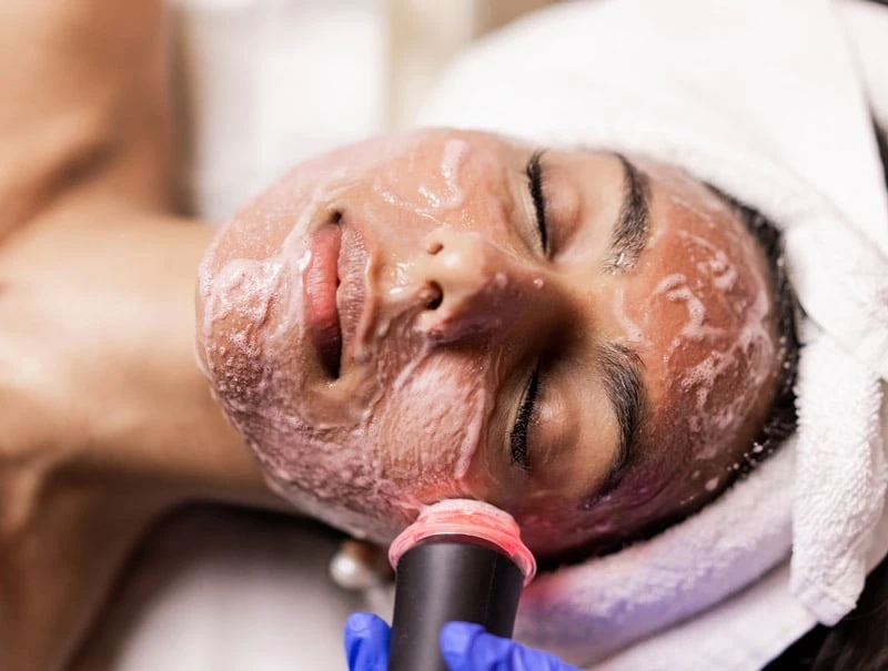 What is the Relevance of Microdermabrasion Facial Treatment?