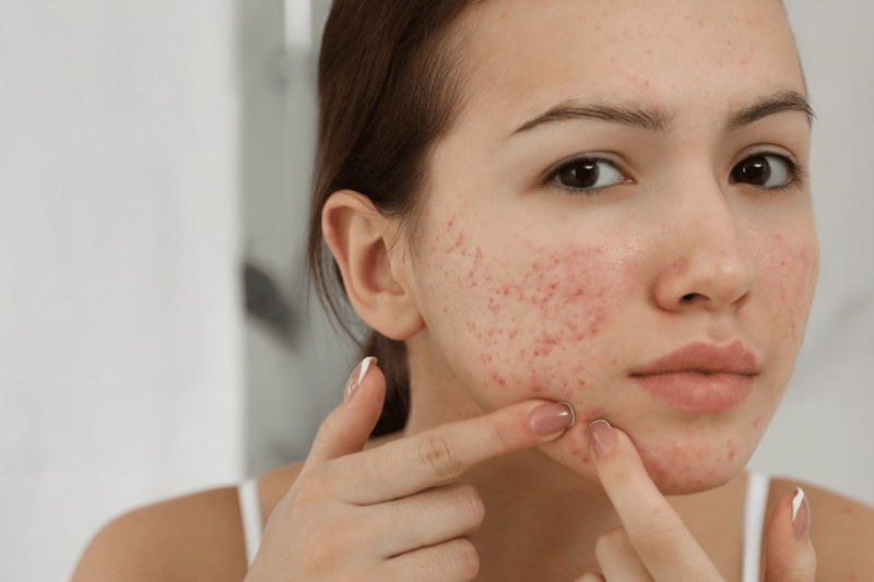 How long does benzoyl peroxide purging last?