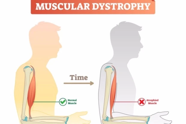 From Diagnosis to Cure: A Comprehensive Guide to Duchenne Dystrophy