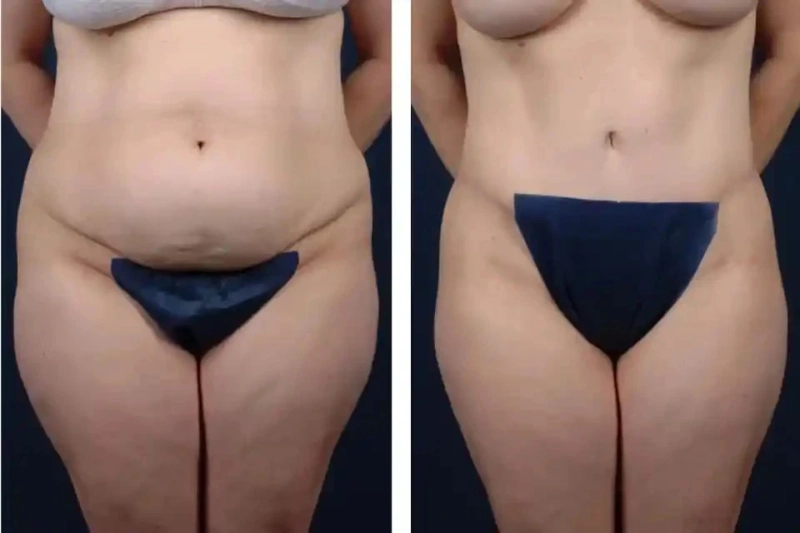 Mini Tummy Tuck vs. Liposuction: Which is Right for You in Dubai?