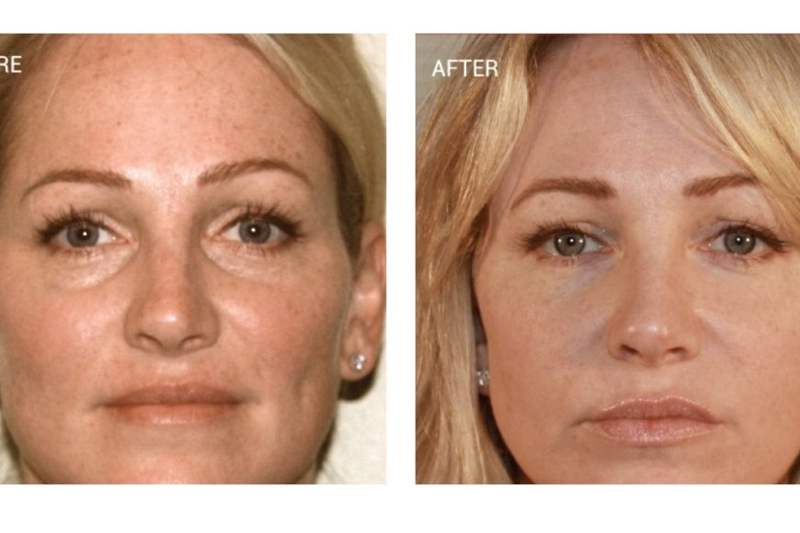 PRF Treatment Harnessing the Power of Growth Factors for Healing