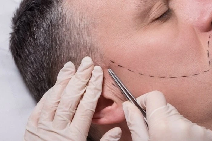 No More Drawing Them In: Eyebrow Transplant for Naturally Full Brows
