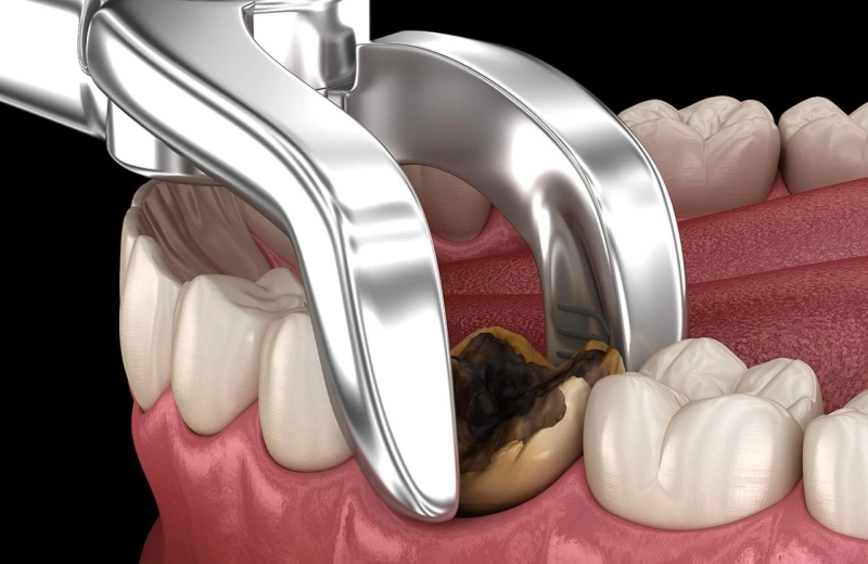 Tooth Extractions - The Process and Types of Tooth Extractions