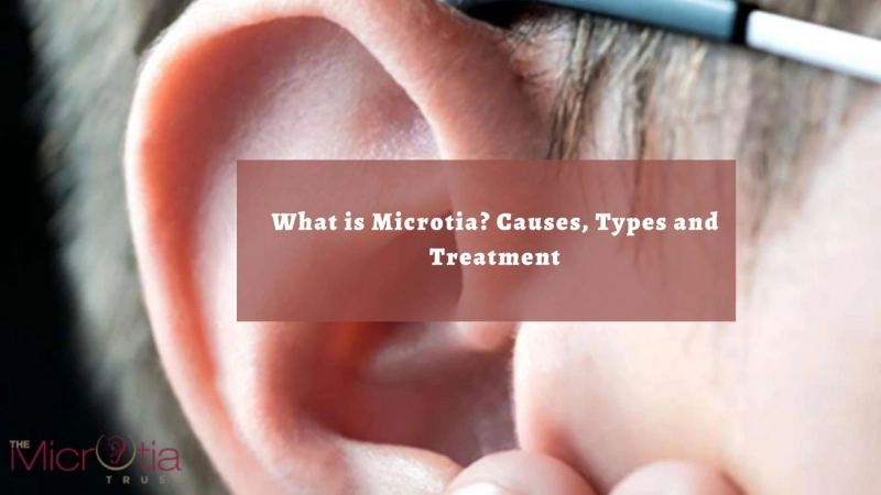 What is Microtia? Causes, Types and Treatment