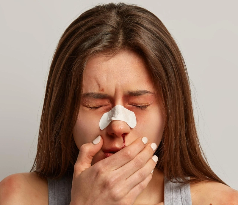 Epistaxis (Nose Bleed): Causes, Symptoms, and Home Remedy