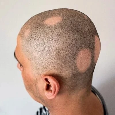 Comparing Traditional and Modern Approaches to Alopecia Areata