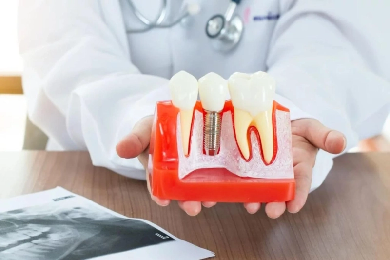 Evolution of Single Tooth Implant in Lebanon