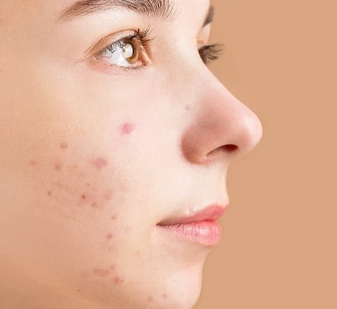 Holistic Approaches to Acne: Integrating Skincare and Lifestyle Changes