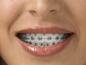 Orthodontics: Achieving a Confident Smile with Modern Braces