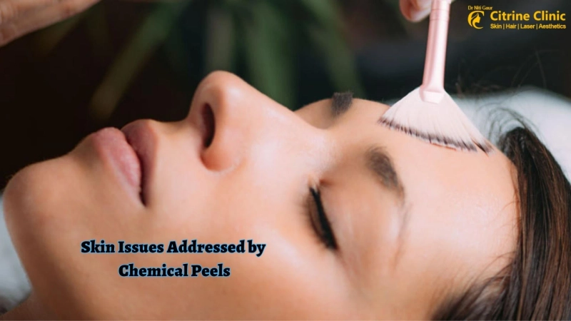 Skin Issues Addressed by Chemical Peels