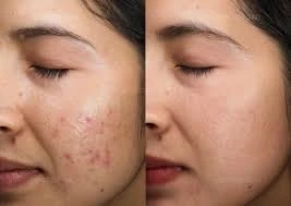 Common Procedures at Acne Treatment Clinics and Their Effectiveness