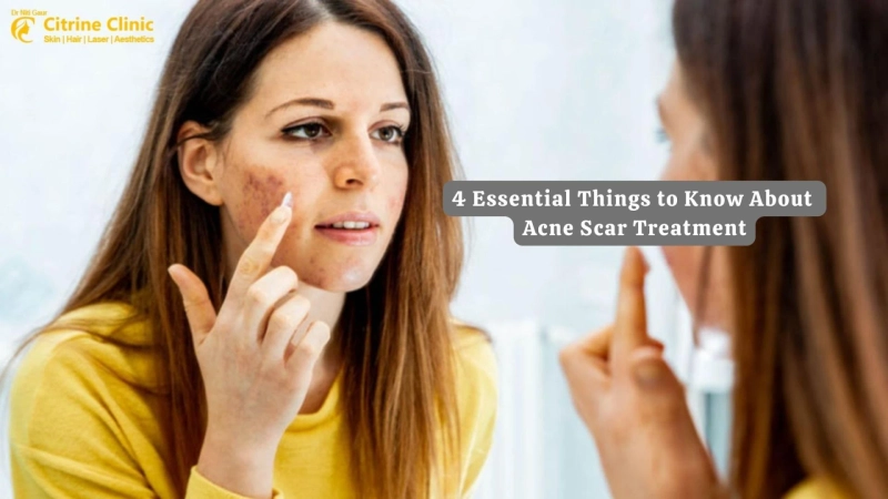 4 Essential Things to Know About Acne Scar Treatment