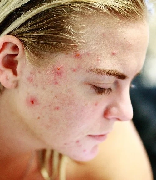 Acne scar treatment in Hyderabad | Inform Clinics