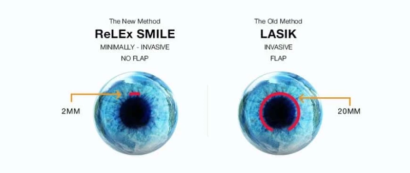 ReLEx SMILE vs. LASIK: The Main Differences Every Patient Should Know