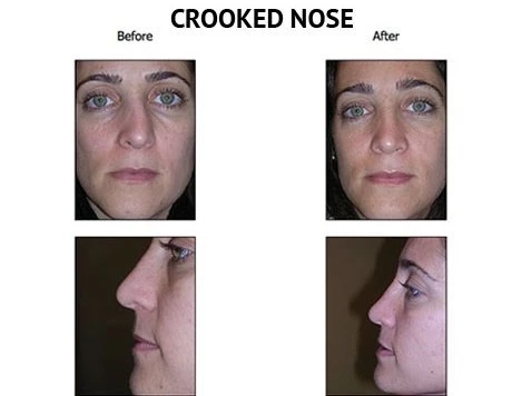 Some Common Rhinoplasty Side Effects