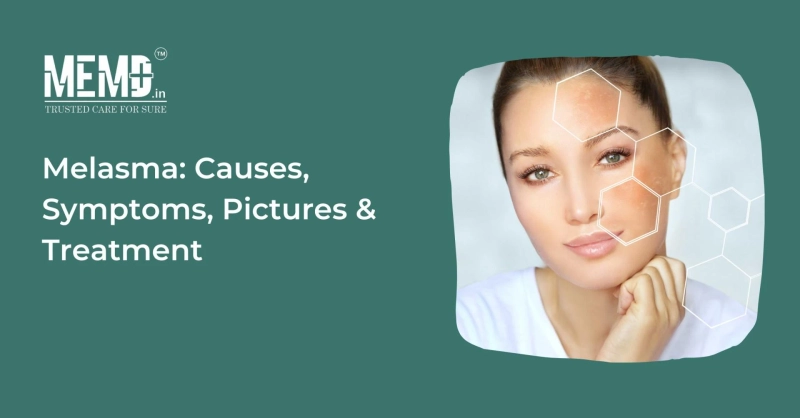 Melasma: Causes, Symptoms, Pictures & Treatment