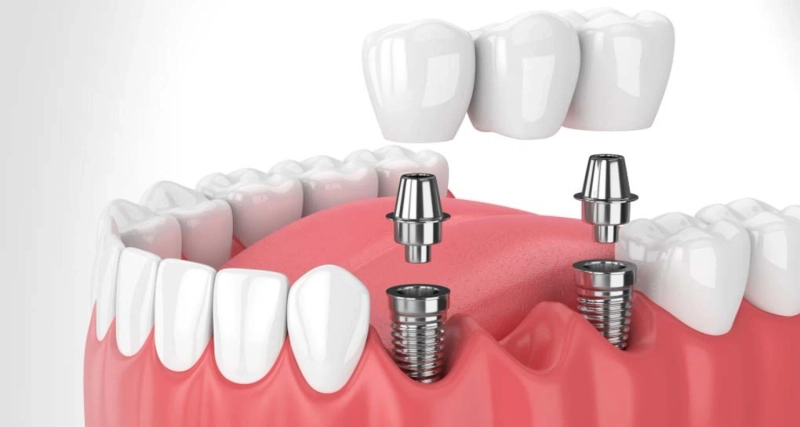 Dental Bridges - What Types of Dental Bridges are Available?