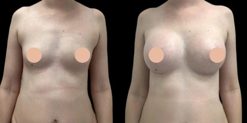 Where to Book the Best Breast Augmentation Surgeons in Dubai