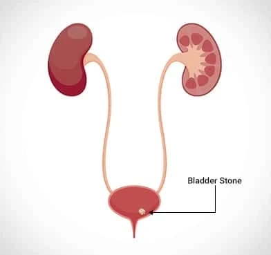 Bladder Stone Surgery in Delhi: Delhi Urology Hospital