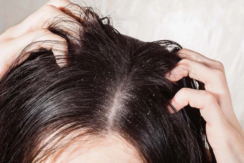 Tackling Dandruff