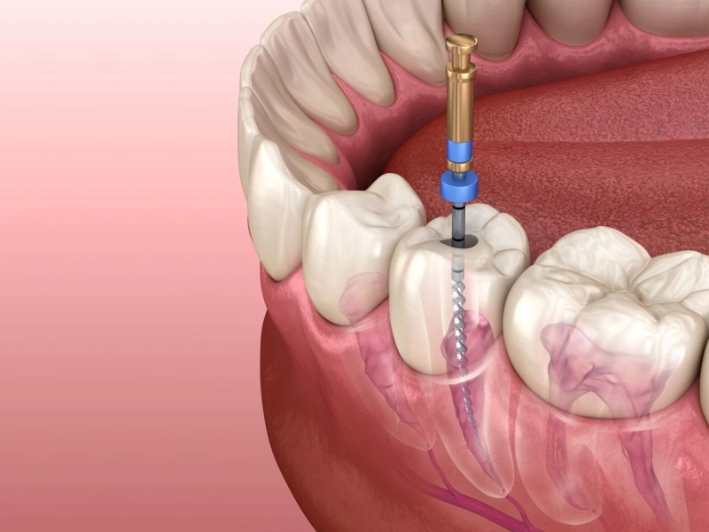 Advantages and Disadvantages of Root Canals