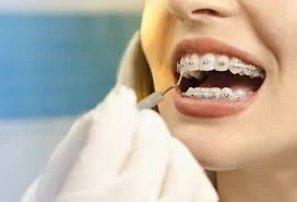 تقويم دامون مقابل تقويم الأسنان التقليدي: ما هو الفرق؟