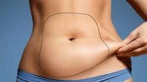The Art of Liposuction: Reshaping Beauty