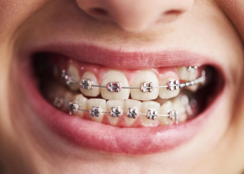 Who Is the Best Orthodontist for Teens in Oostburg?