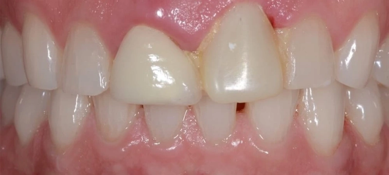 5 Killer Techniques to Cure Your Bad Breath Naturally Forever