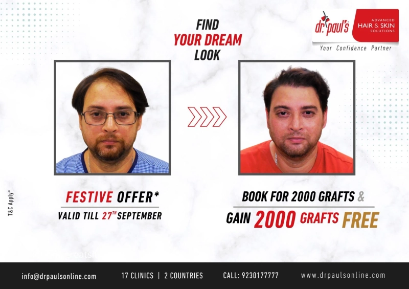 Hair Transplant Cost in India (2025) – Everything You Need to Know