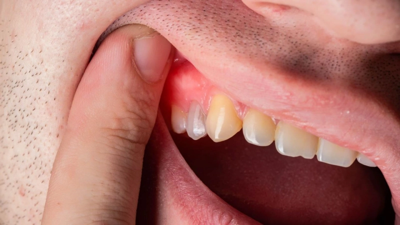 How to Prevent Gum Pimples and Keep Your Gums Healthy
