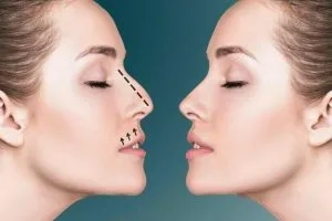 Nose Reshaping Surgery: Essential Facts You Should Know