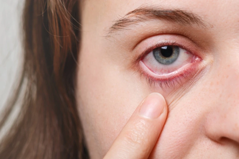 Lack of Sleep: A Hidden Cause of Common Eye Problems