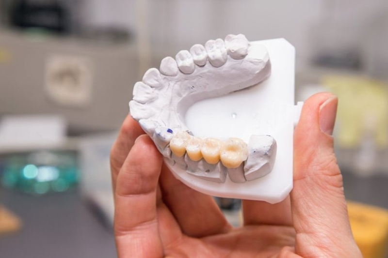 The Art of Dental Aesthetics: Understanding the Esthetic Bridge