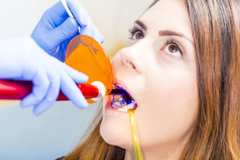 Why You Should Consider Dental Bonding for Minor Smile Corrections