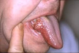 Oral Cancer Surgery: How Much Does it Cost in India?
