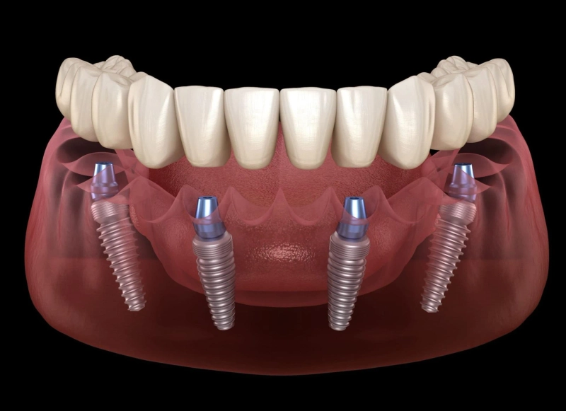 Revolutionizing Tooth Replacement: All-on-4 Dental Implants in Derby