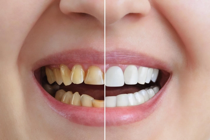 Finding the Best Teeth Whitening Treatment for You