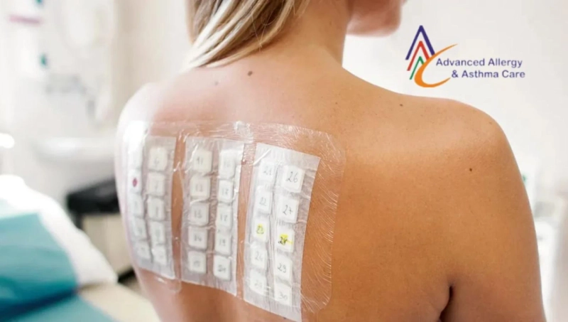 All You Need to Know about Allergy Patch Testing