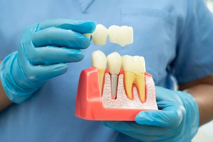 Everything You Need to Know About Full Mouth Dental Implants in Derby