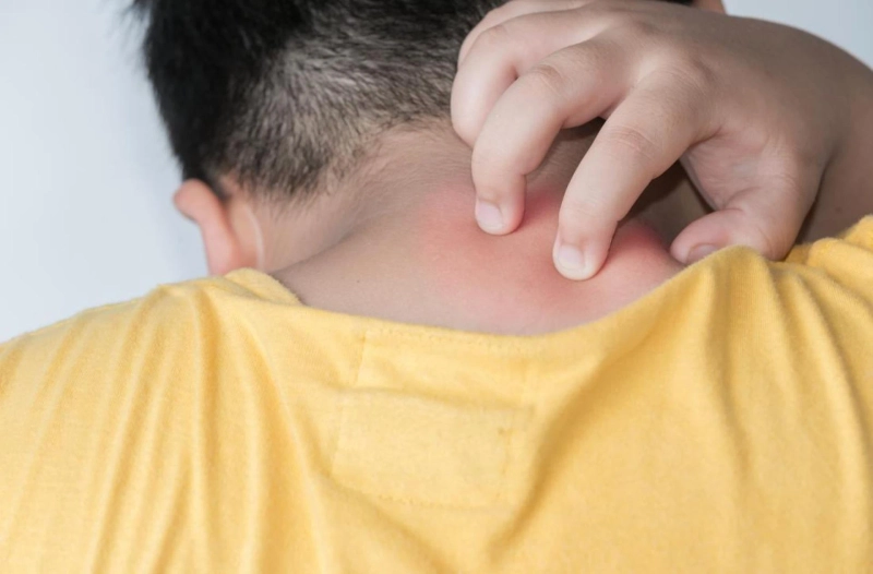 When to See a Doctor for Spongiotic Dermatitis
