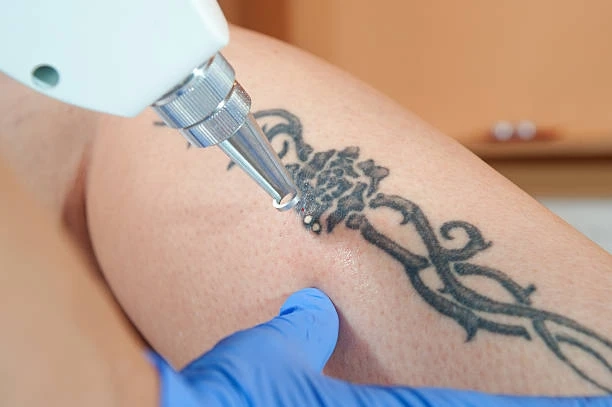 Understanding the Science Behind Laser Tattoo Removal in Riyadh
