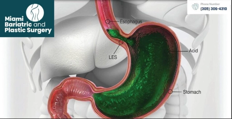 Transforming Lives with Bariatric Surgery in Miami, FL: A Path to Sustainable Weight Loss
