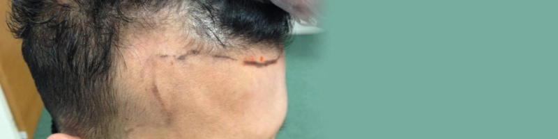 Can I Have Hair Transplant On Burnt Skin?