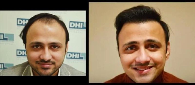 Success Story of DHI Patient- Best Hair Transplant Technique in Bangalore,India