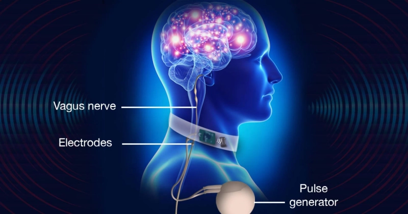 Forecasting 2022-2028: Global Vagus Nerve Stimulators Market trends, share, size, growth, opportunities, and forecasts