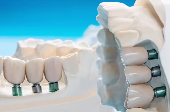 Dental Implants: Benefits for Smile, Bone Health and Function