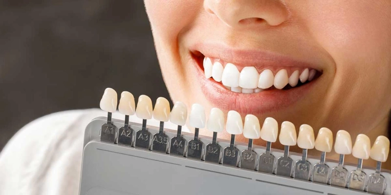 What Are the Primary Benefits of Composite Veneers?